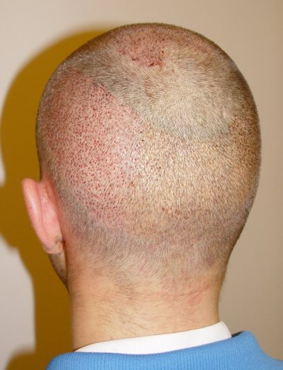 Haartransplantation mit FUE: Unmittelbar nach der OP von links hinten