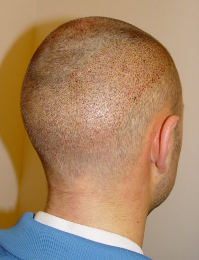 Haartransplantation mit FUE: Unmittelbar nach der OP von links hinten