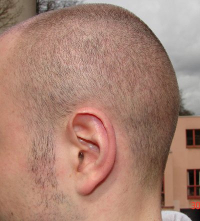 Haarkranz 4 Wochen nach der FUE Haartransplantation von links hinten rasiert auf 1 mm