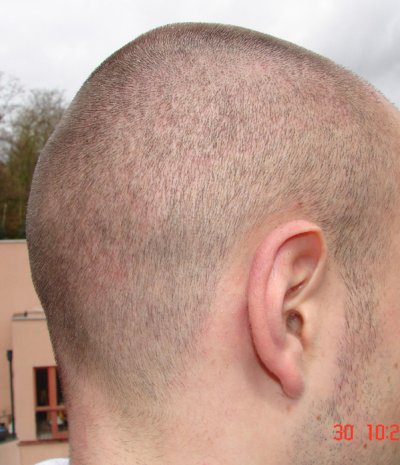 Haarkranz 4 Wochen nach der FUE von rechts hinten rasiert auf 1 mm 4 Wochen nach der FUE von rechts hinten rasiert auf 1 mm