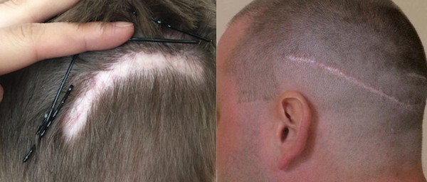 Haartransplantation Risiken bei der FUT Technik im Haarkranz: Breitere sichtliche Narben