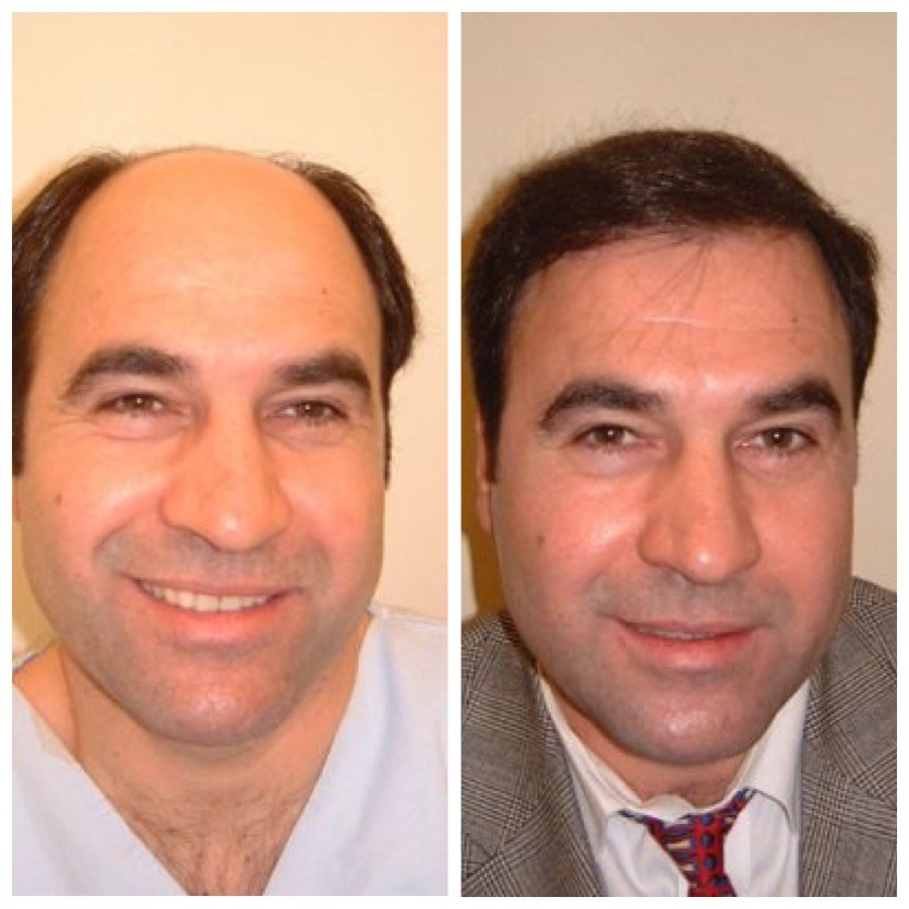 Glatze oder Haarverpflanzung? Beispiel vor und nach der Glatzenbeseitigung von vorne