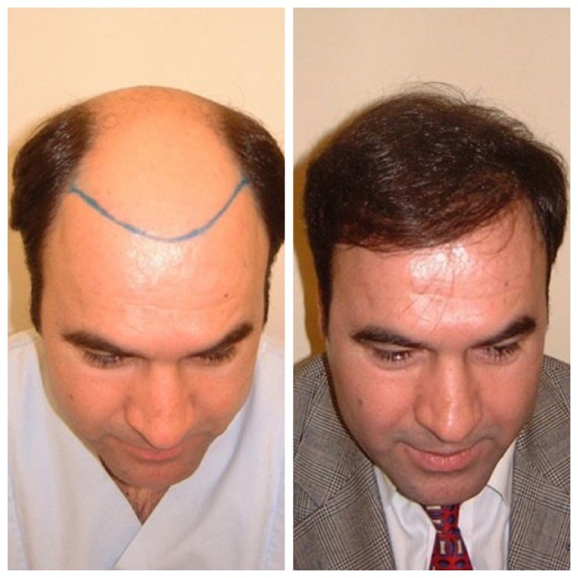 Glatze beseitigen oder eine Haartransplantation durchführen? Beispiel vor und nach der Op