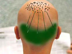 Fester Haarkranz: Das Entnahmegebiet für eine Haarwurzeltransplantation