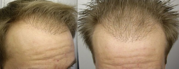 Risiken im Empfangsbereich: Dicke Grafts in der Haarlinie bilden bei einer Haartansplantation einen unnatürlichen Klobürsten-Look