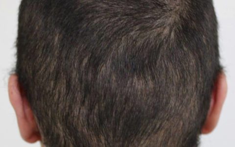Ausgedünnter Haarkranz nach einer verpfuschten FUE Haartransplantation in Istanbul: Vorher mit längeren Haaren - 2
