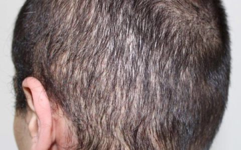 Ausgedünnter Haarkranz nach einer verpfuschten FUE Haartransplantation in Istanbul: Vorher mit längeren Haaren