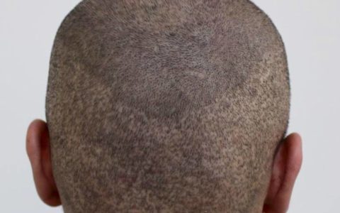 Ausgedünnter Haarkranz nach der verpfuschten: Vorher mit Rasur - 2