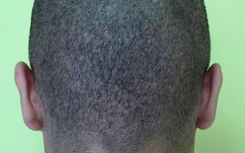 Resultat der Scalp-Pigmentation nach verpfuschten FUE Haartransplantation in der Türkei