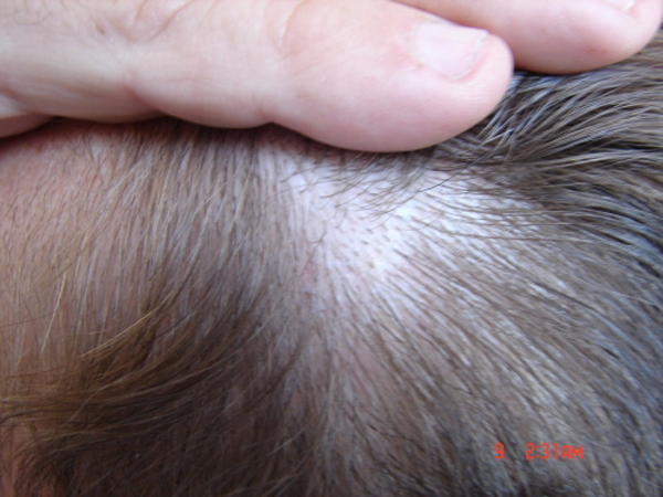 Gemessene Dichte im Bereich der Schläfen und im seitlichen Haarkranzgebiet: 50 FU`s pro qcm