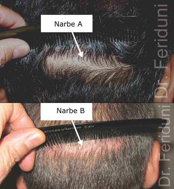 Vergleich der Narbe nach einer FUT Haartransplantation ohne und mit Trichophytic-Closure Verschlusstechnik