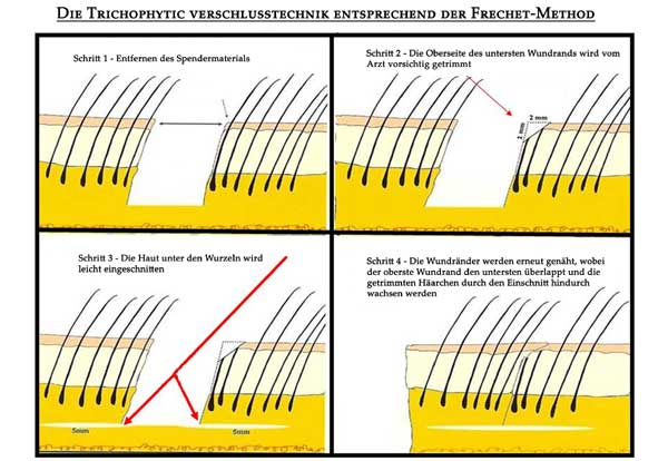 Ziel Verringerung von sichtbarem Narbengewebe: Skizze der Trichophytic-Closur-Verschlusstechnik bei FUT Haarverpflanzung 