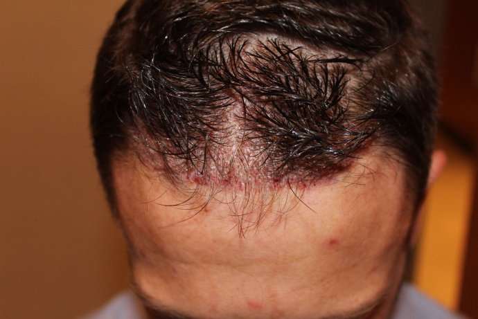 Haar-OP ohne Rasur der Empfangszone - Erhöhung der Haardichte