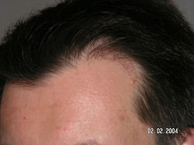 Februar 2014. Nach der Haarverpflanzung. Linke Ecke, weiterhin Rötungen