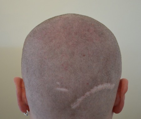 Verpfuschtes Resultat - Narbe im Haarkranz nach einer Haartransplantation in Deutschland