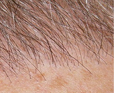 Beispiel einer gelungenen Haartransplantation: Ausschliesslich Einzelhaar-Grafts in vorderster Reihe