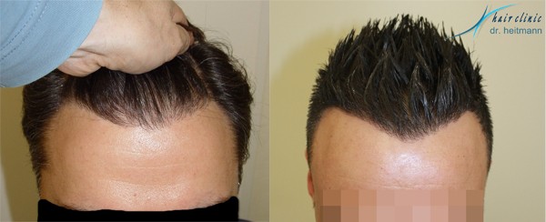 Haartransplantation Ausland: Eine Haar-OP günstig im Ausland aber gut beim Spezialisten!