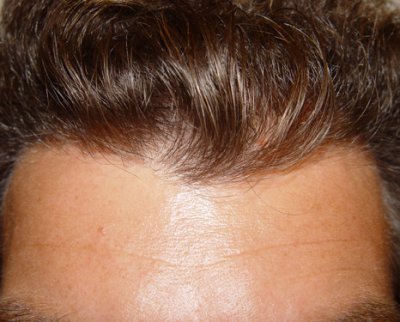 Beispiel 2 einer gelungenen-natürlichen Haarverpflanzung mit Dense Packing - von vorne