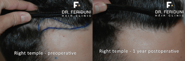 Haartransplantation Geheimratsecken Beispiel: Rechte Ecke links vor und rechts nach der Behandlung