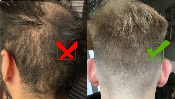 Haartransplantation Türkei Vergleich links misslungene FUE in einer Klinik in Istanbul und rechts eine gelungene FUE Entnahme in einer Klinik in Ankara (beide Fälle je 3000 Grafts)