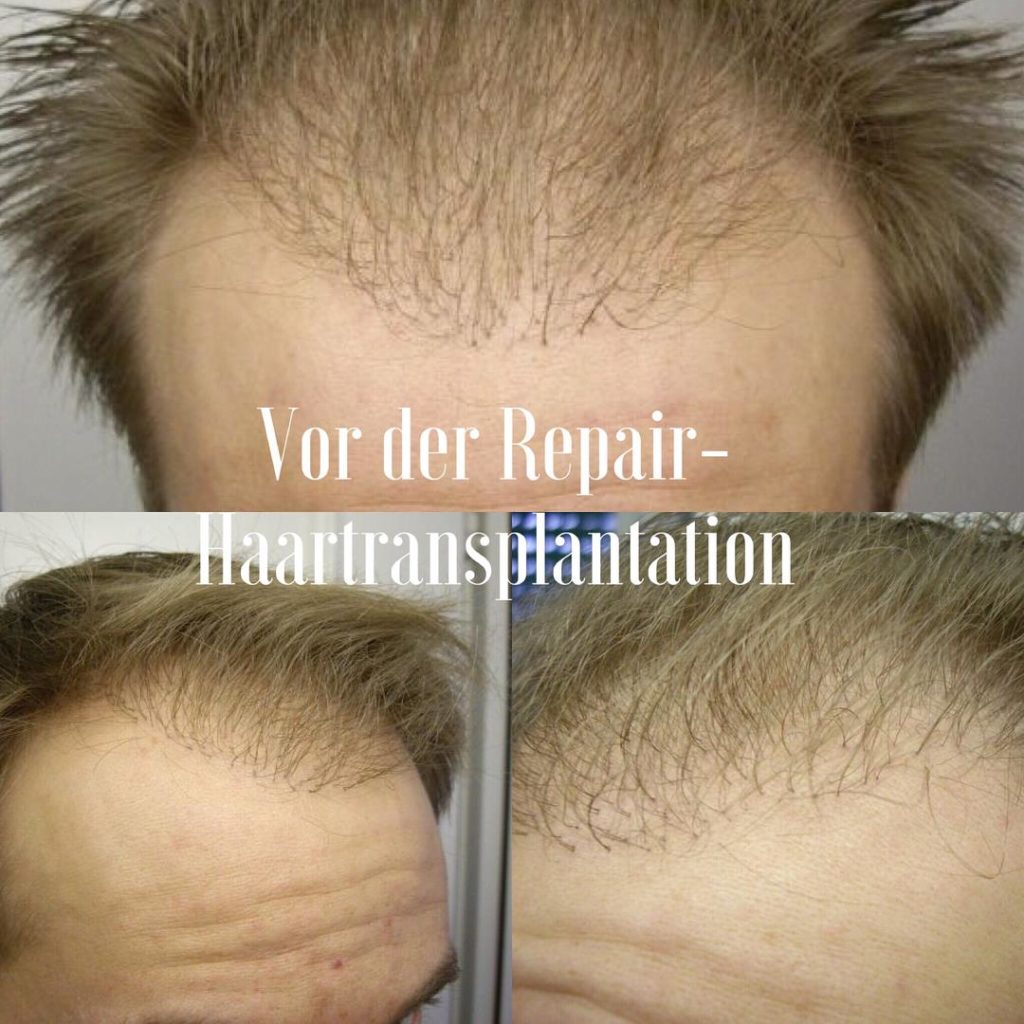 Haartransplantation Kliniken Deutschland
