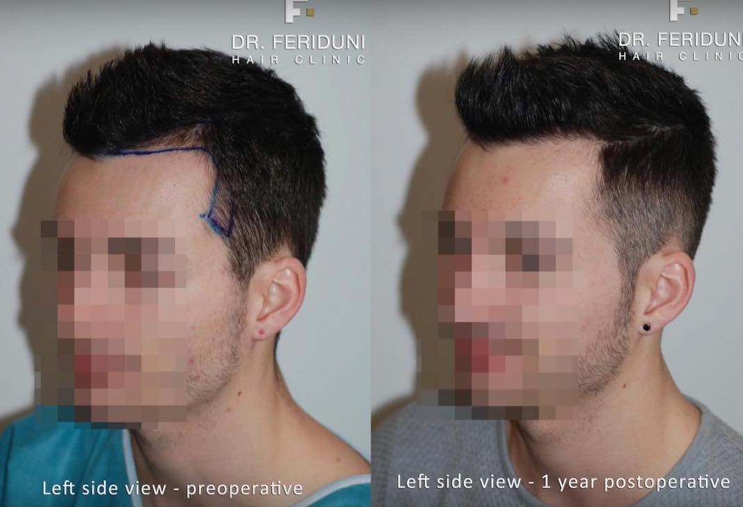 Haartransplantation bei Geheimratsecken: Linke Ecke vor und nach der OP, Graftanzahl gesamt 1401 Grafts Dr. Feriduni