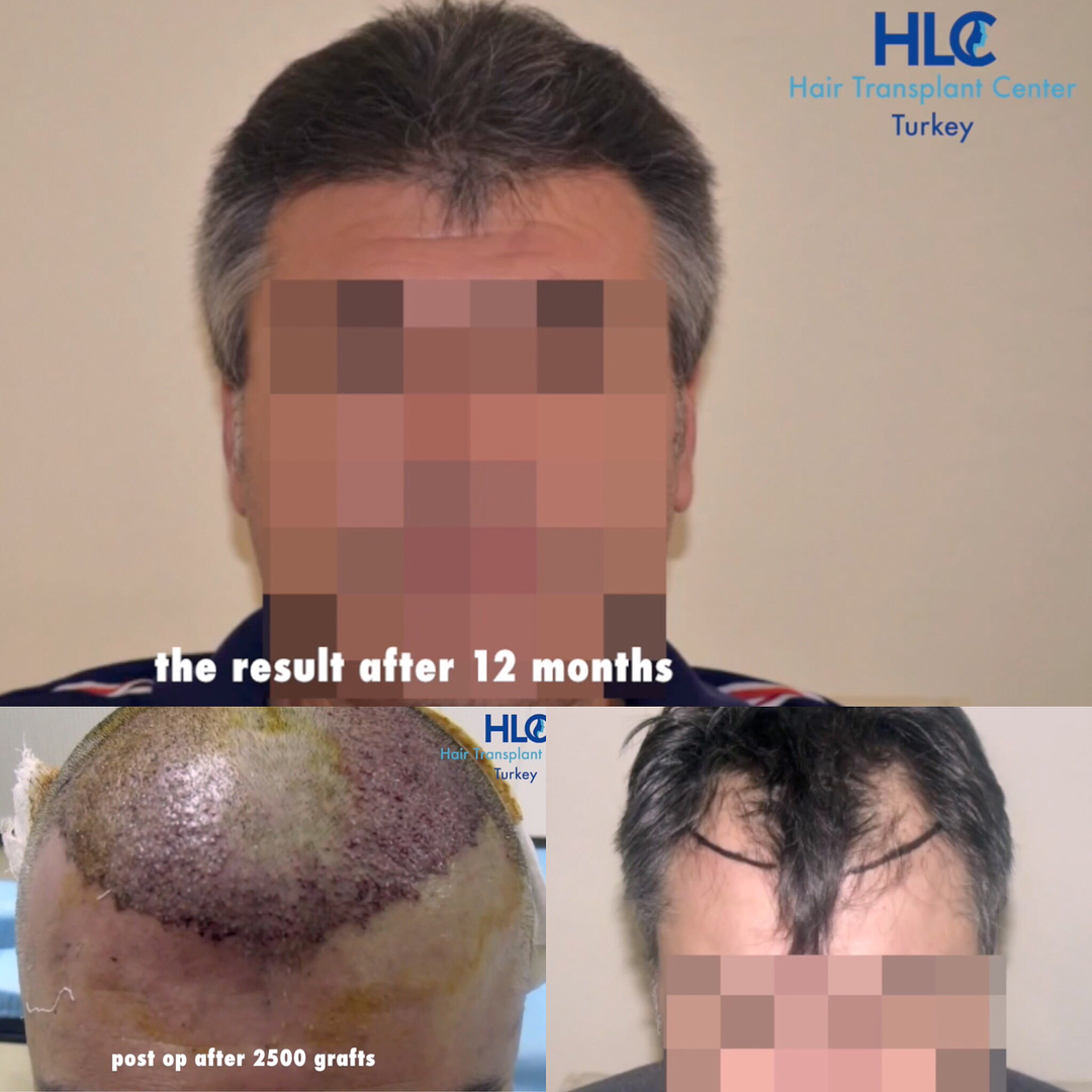 Eine typisches Haartransplantation Geheimratsecken Vorher Nachher Beispiel von der Hairlineclinic in der Türkei