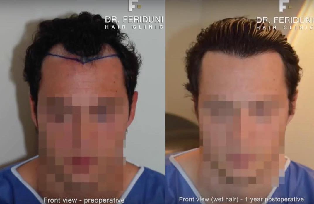 Vorher Nachher Beispiel der Ecken-Haaroperation mit 2485 Grafts Dr. Feriduni