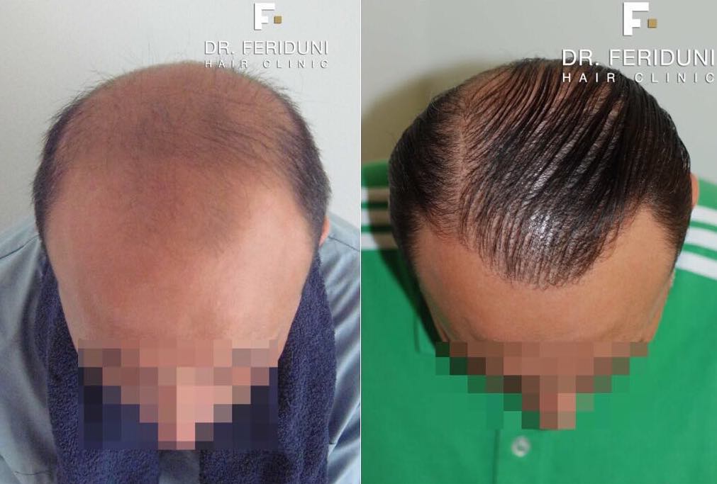 Haartransplantation Glatze Vorher Nachher