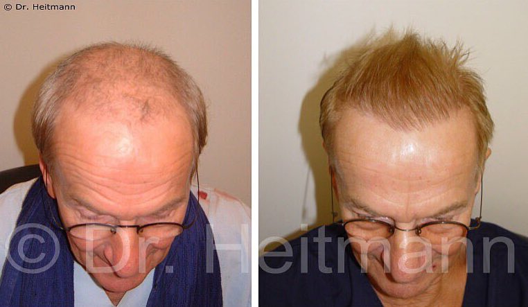 Haartransplantation Glatze Vorher Nachher