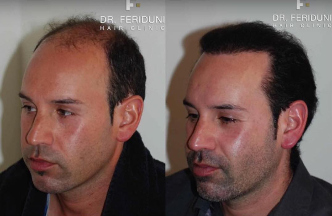 Haartransplantation Glatzen Vorher Nachher Bilder