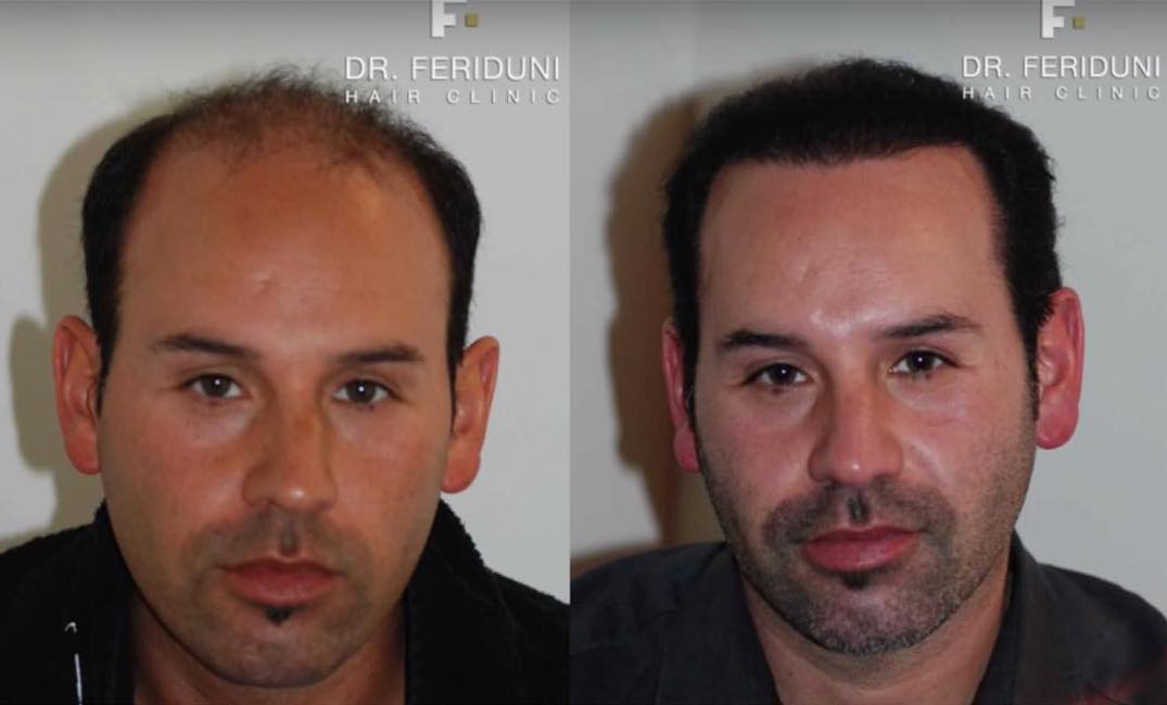 Haartransplantation Glatzen Vorher Nachher Bilder