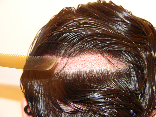 Eine FUE Haartransplantation mit lediglich einer Streifen-Rasur