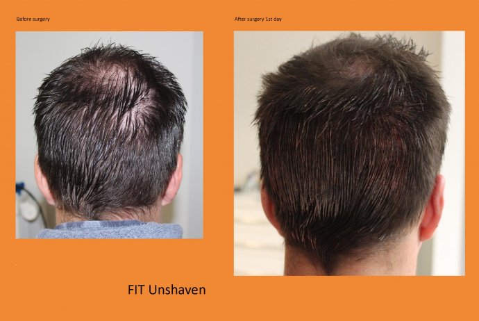 Unshaven-Behandlung ohne jegliche Rasur weder im Empfangs- noch im Entnahmebereich, hier ein Bild des Donors direkt Post-OP