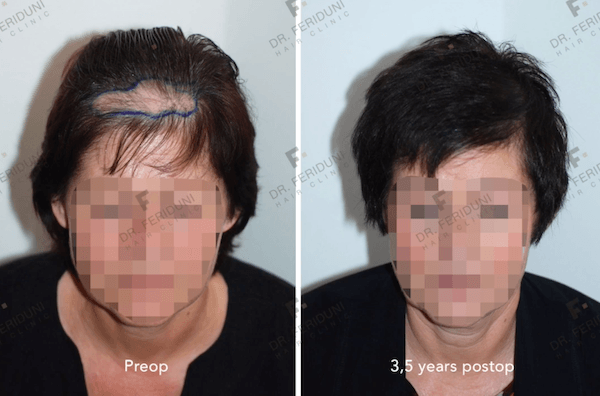 Haarverdichtungen: Links vor und rechts nach der Haarauffüllung durch Eigenhaartransplantation