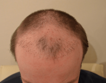 Haarverpflanzung Risiken einer schlechten und geringen  Anwuchsrate Beispiel 2