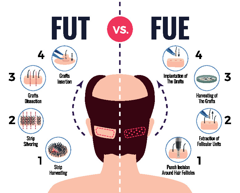 Thema Haartransplantation und Zukunft Haare klonen/Bild FUE und FUT 