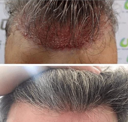 Haartransplantation ohne Rasur – rasieren