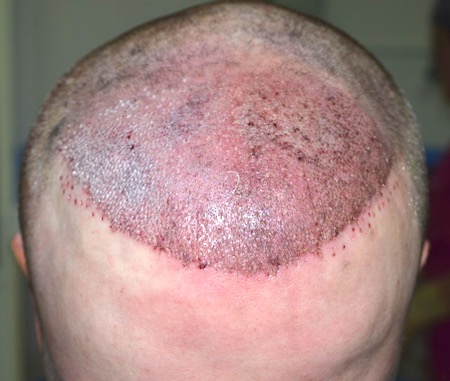 Reparatur der schlechten Haartransplantation in Deutschland: Direkt nach der Repair-OP bei Dr. Özgür Öztan - Hairlineclinic
