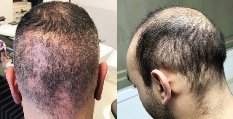 Haartransplantation Risiken: Beispiel schlechtes Ergebnis mit übermässiger Entnahme Beispiel schlechtes Ergebnis mit übermässiger Entnahme