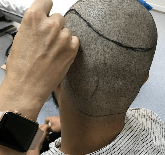 Haartransplantation am Bosporus und zerstörter Haarkranz nach einer FUE - Vorher