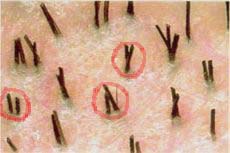 Bedeutung von Follicular Units bei der FUE Haartransplantation Technik: Follicular Units = Follikuläre Einheiten - Haare wachsen in natürlichen Bündelungen mit 1 bis 4 Haarfollikel