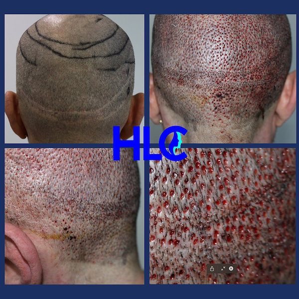 Ziel die Haartransplantation Narbe im Spenderbereich zu entfernen: Bild vor der Narbenkorrektur und direkt nach der FUT-Reparatur durch FUE mit 700 Grafts