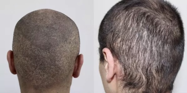 Dezimierter Spenderbereich und Narben nach nicht erfolgreicher FUE Haartransplantation