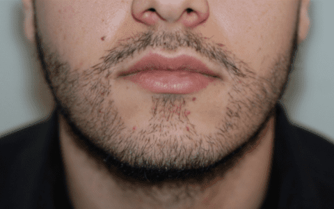 Welche Risiken geht man für bei einer Haartransplantation für einen neuen Bart ein? Kann eine Barttransplantation gefährlich sein? 