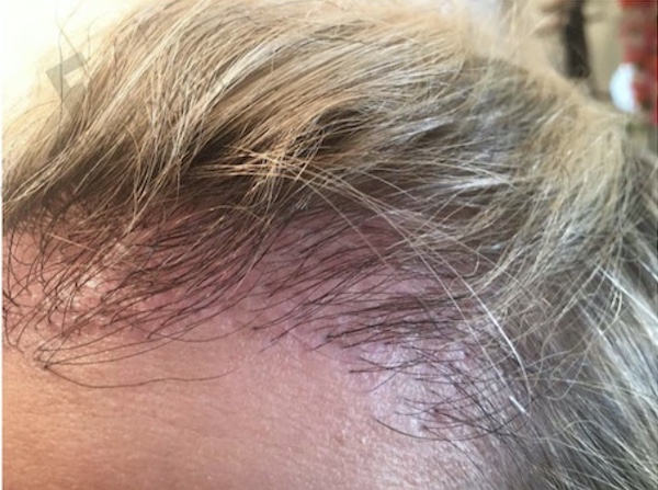 Risiken einer Haartransplantation bei Frauen: Weiblicher Patient nach misslungener OP: Unzureichende Dichte, vereinzelt dicke Grafts in der Front