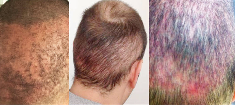 Haartransplantation Risiken: Entzündete, vernarbte Kopfhaut und dezimierte Haarkränze: Massive Probleme durch übermässige Entnahme bei der FUE Technik: Bilder ISHRS.org