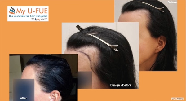 Haartransplantation bei Geheimratsecken Frauen Beispiel 2 mit 1010 Grafts 