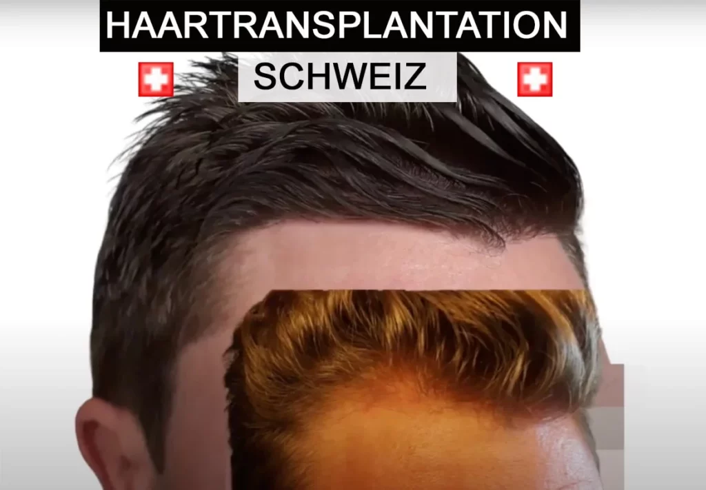 Haartransplantation Schweiz Ärzte und Kliniken