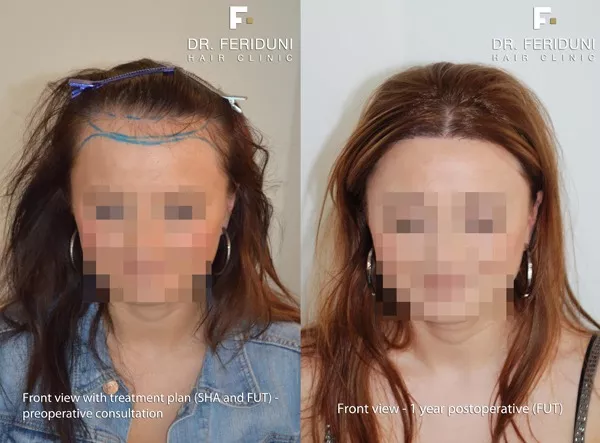 Haartransplantation für Frauen: Beispiel hohe Stirn Frauen - 2